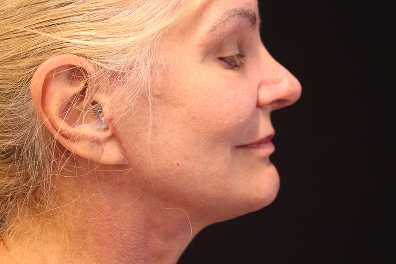 Facelift Before & After Image