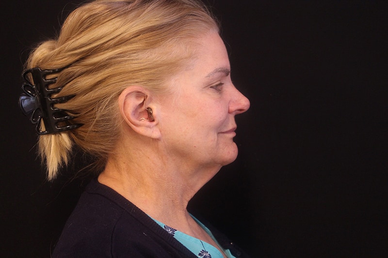 Facelift Before & After Image