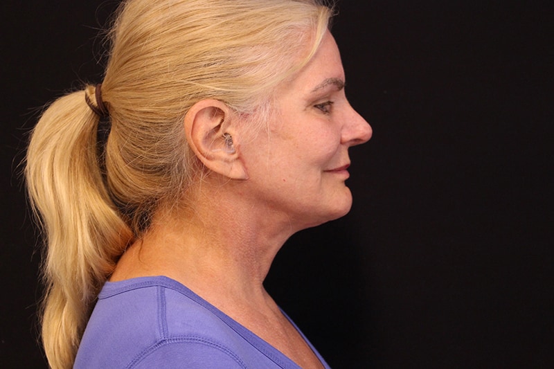 Facelift Before & After Image