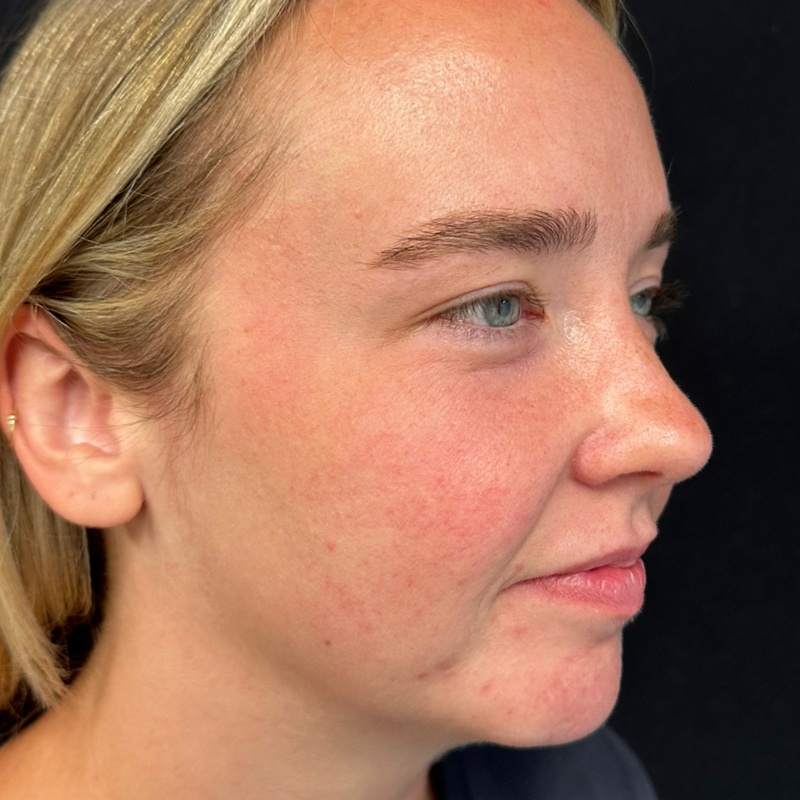 Chin Fillers Before & After Image