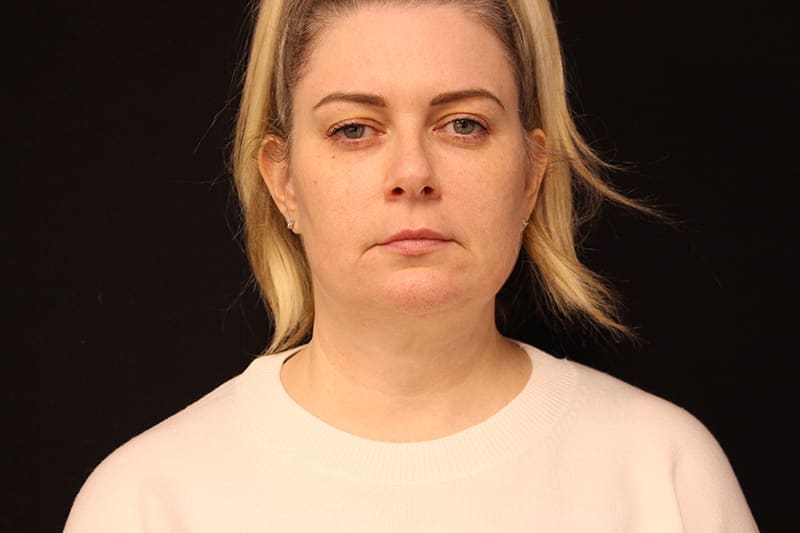 Facetite Before & After Image