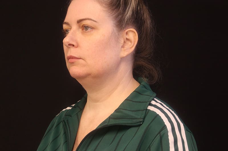 Facetite Before & After Image