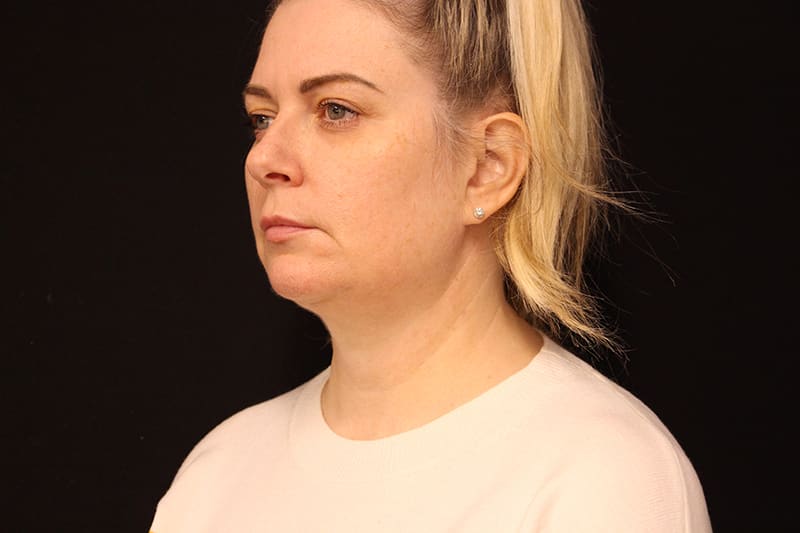 Facetite Before & After Image
