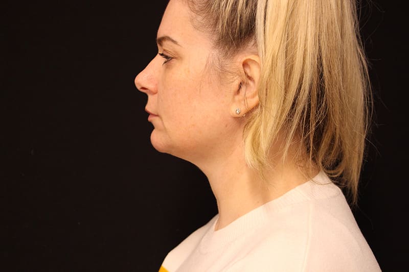 Facetite Before & After Image