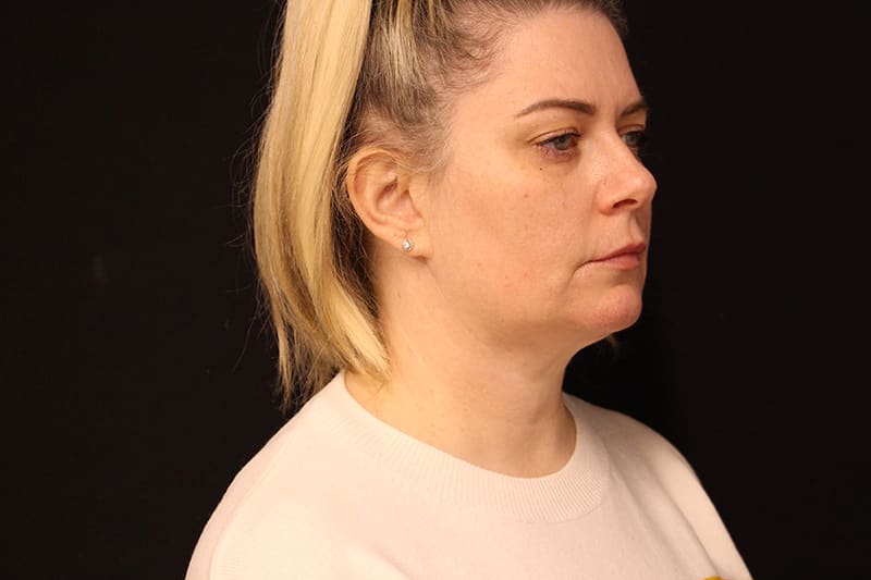 Facetite Before & After Image