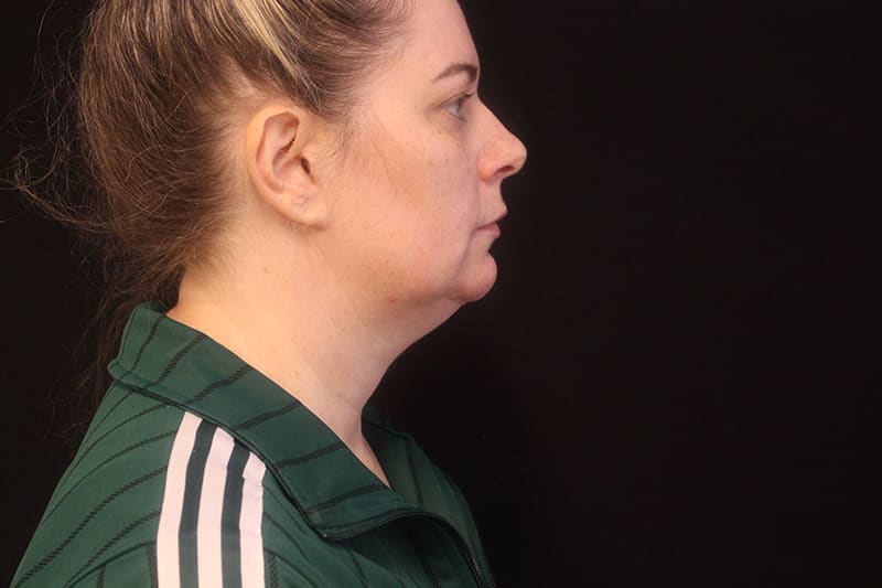 Facetite Before & After Image