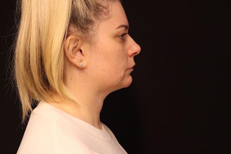 Facetite Before & After Image