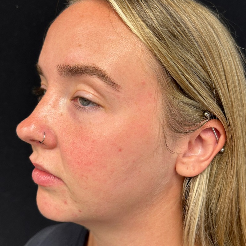 Jawline Fillers Before & After Image