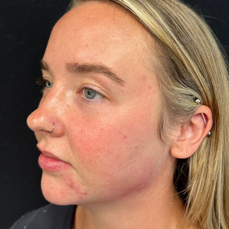Jawline Fillers Before & After Image