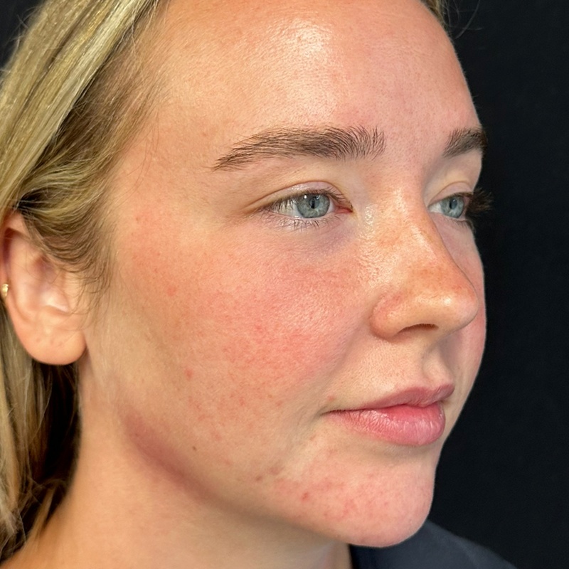 Jawline Fillers Before & After Image